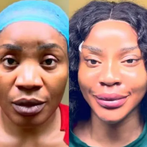I Don’t Even Like How I Look — Actress Uche Ogbodo Speaks After Facial Rejuvenation