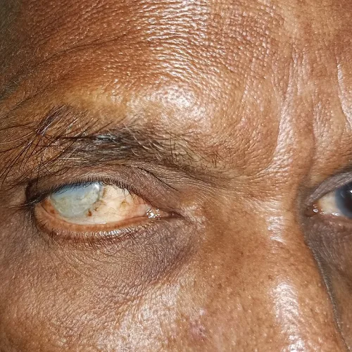 Cataracts drive avoidable blindness in over two million Nigerians – Ophthalmologist